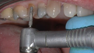 Figure 3: Buccal and lingual reduction of tooth No. 4