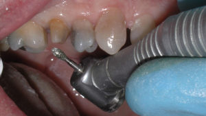 Figure 4: Occlusal reduction and shaping is accomplished with a football diamond