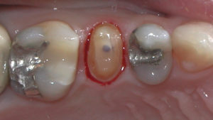 Figure 5: Final preparation of tooth No. 4 after placing a circumferential bevel with a fine grit flame diamond