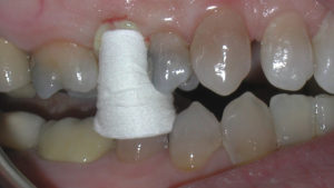 Figure 6: Tissue management for tooth No. 4 is achieved using Traxodent gingival retraction paste and a Retraction Cap (Premier)