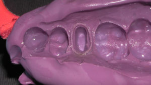 Figure 8: Final impression of tooth No. 4 with polyether impression material and T Loc Triple Tray (Premier)