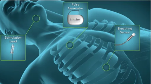 Inspire Upper Airway Stimulation Therapy, developed by Inspire Medical Systems, a technology company in Maple Grove, Minnesota, is a device comprising electrodes that’s implantable in the muscle that controls the tongue and prevents it from relaxing, drifting back and blocking the airway during sleep. The stimulation is so slight that patients don’t feel it. ( Photo courtesy Inspiresleep.com )