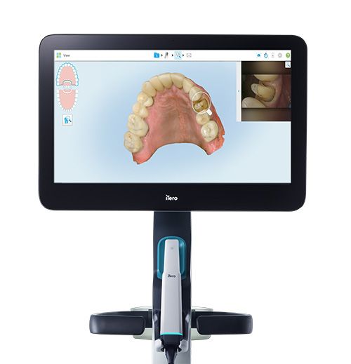 iTero’s New Hero 