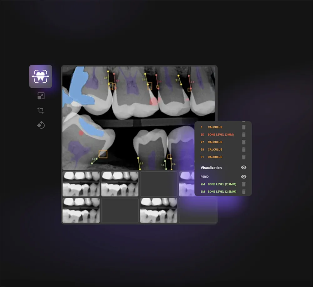 Overjet AI detects oral diseases with precision, ensuring dentists can offer the best care.